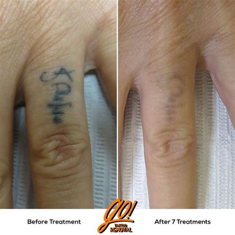 nude tattoo removal|tattoo removal on finger.